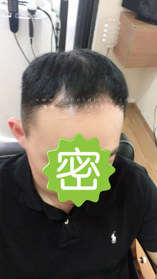 ㎛M